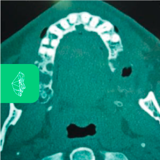 Centro Maxilofacial Talca Tratamientos Comunicaciones Bucosinusales