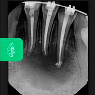 Centro Maxilofacial Talca Tratamientos Comunicaciones Cirugia-Periapical