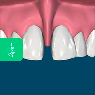 Centro Maxilofacial Talca Tratamientos Frenillos Bucales