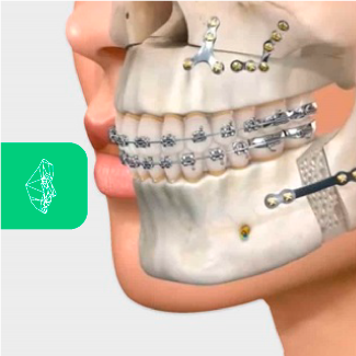 Centro Maxilofacial Talca Tratamientos Ortognatica