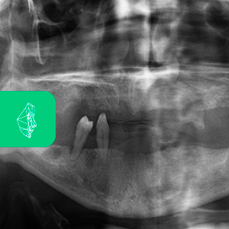 Centro Maxilofacial Talca Tratamientos Quistes Y Tumores Maxilares