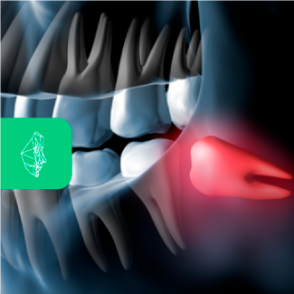 Centro Maxilofacial Talca Tratamientos Terceros Molares