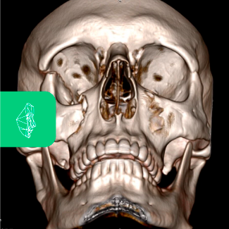Centro Maxilofacial Talca Tratamentos Trauma Facial